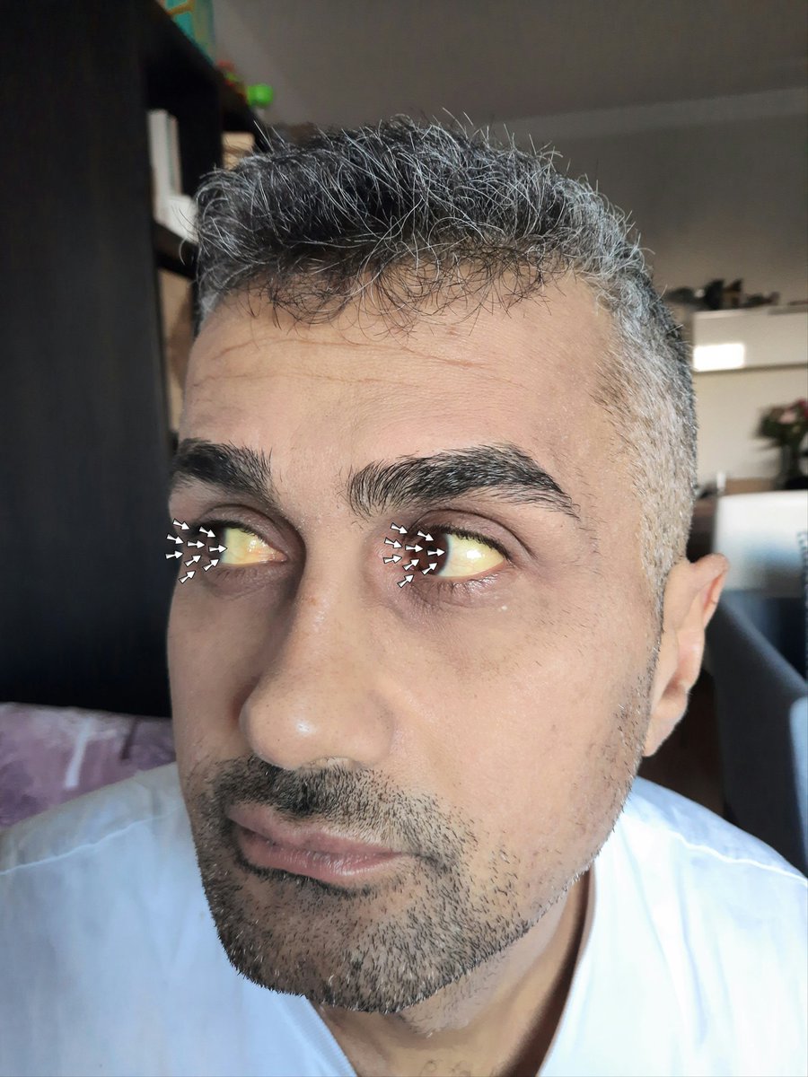 Gözlerdeki sarılık #bilirubin yüksekliğinin işaretidir.Bu da kişinin #karaciğer'inde sorun olduğunu gösterir.

Böyle bir durum var ise;
bilirubin yüksekliğini düşürmek için 1 bardak suya 1 tatlı kaşığı #kimyon atıp cezvede 7-8 dk. kaynatın.
(Ek olarak her gün #sirkencubin içiniz)