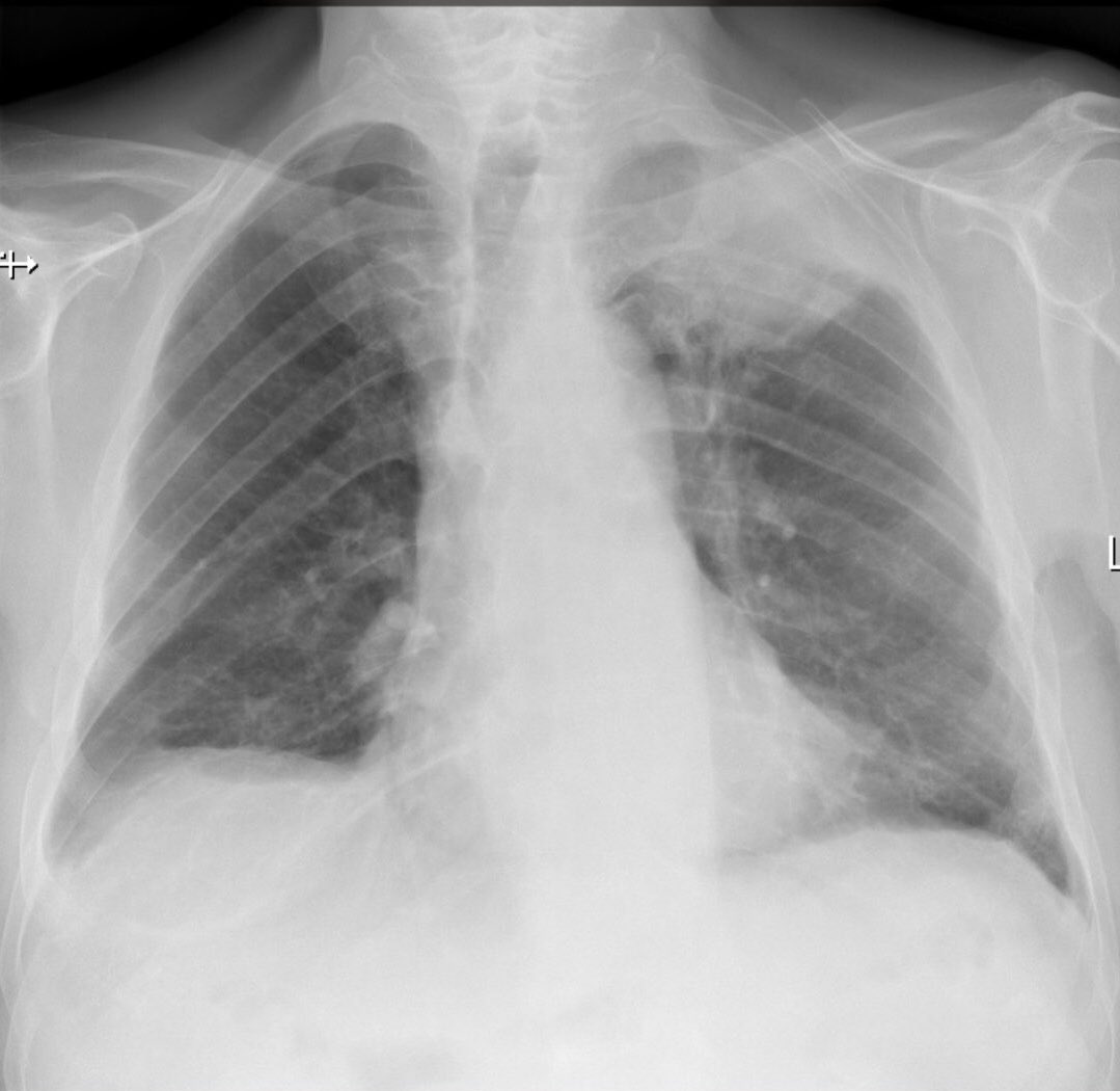 P/C: Shoulder pain 
Diagnosis?
#MedicalGlobe #MG #MedTwitter