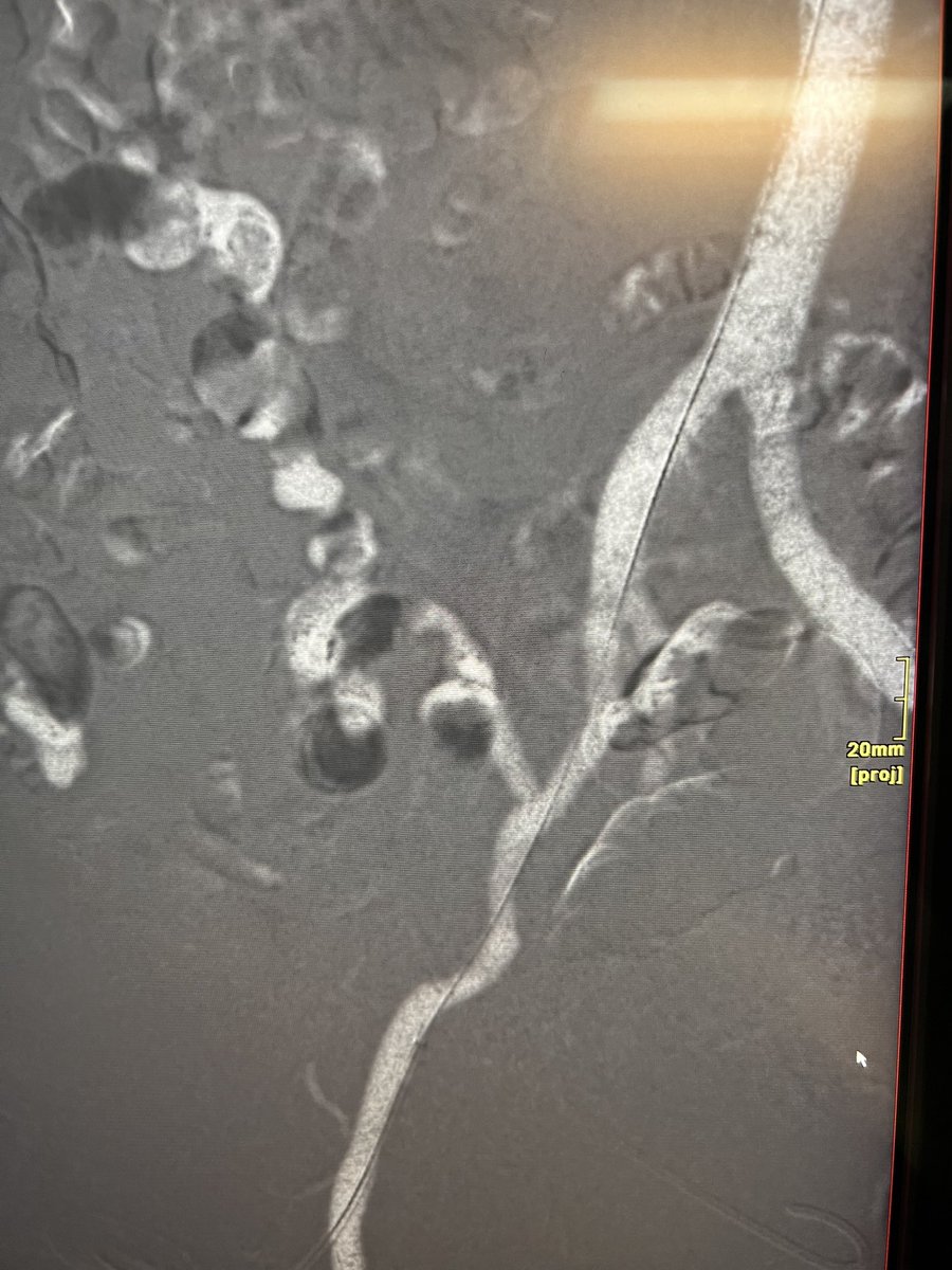CO2 angiography 🥹 #IYKYK #IamIR
