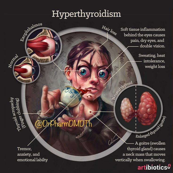 What happens when you have hyperthyroidism? #MedEd #MedTwitter