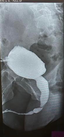 Injerto de mucosa oral - 16 cm para estenosis de uretra bulbar y peniana…técnica @sanjaybkulkarni
