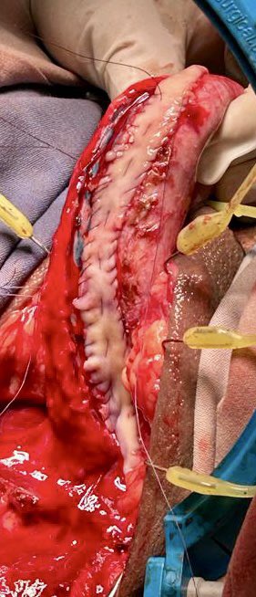 drecabeza's tweet photo. Injerto de mucosa oral - 16 cm para estenosis de uretra bulbar y peniana…técnica @sanjaybkulkarni https://t.co/nbUanITXjP