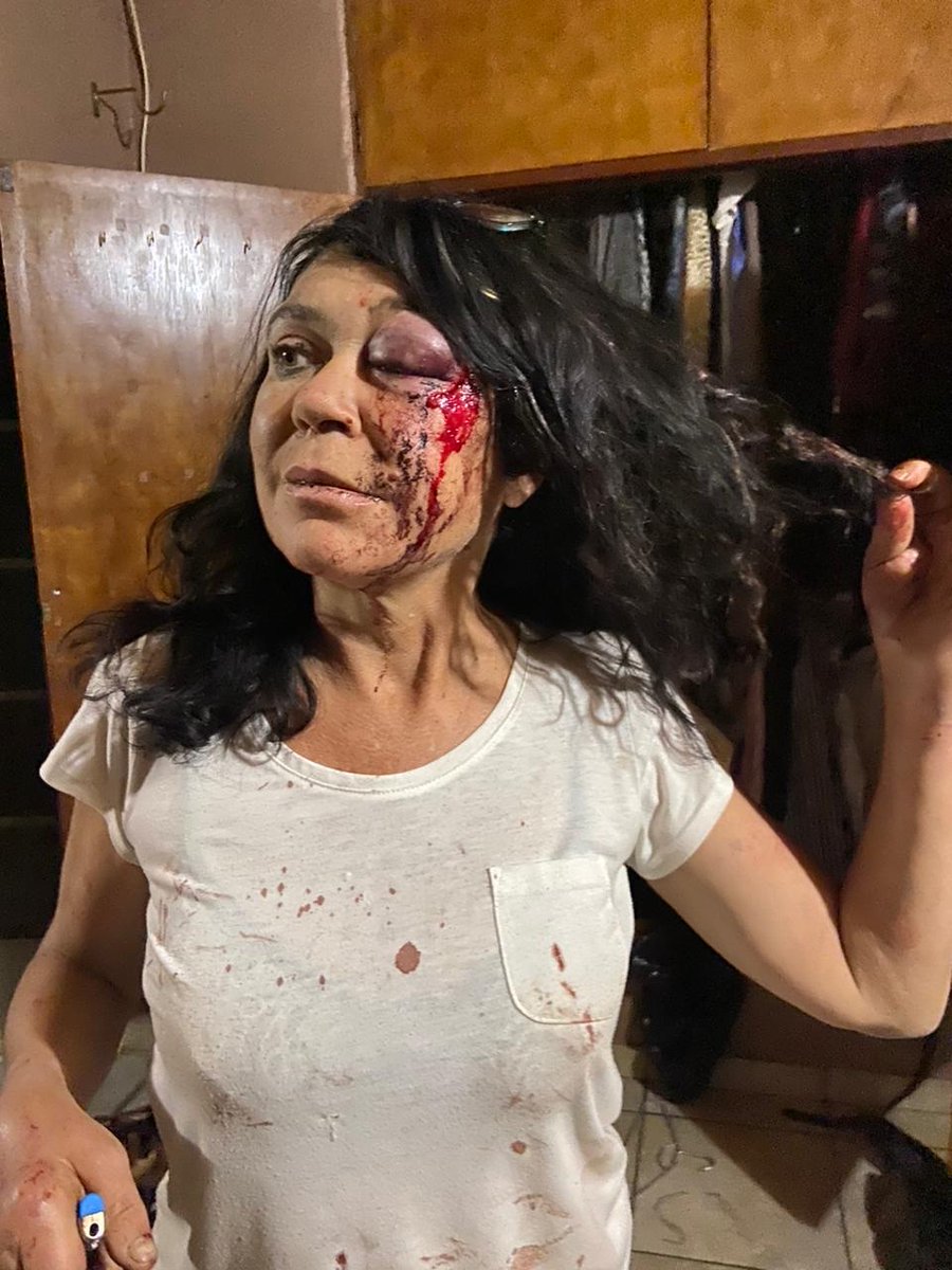 IanCameron23's tweet photo. Wednesday around 17:00, this BRAVE survivor was attacked on a farm close to Vaalwater in Limpopo. She was repeatedly beaten with a crowbar…. 

Here is the full story: https://t.co/9bRgCMoGYC https://t.co/0c2yQxjGpM