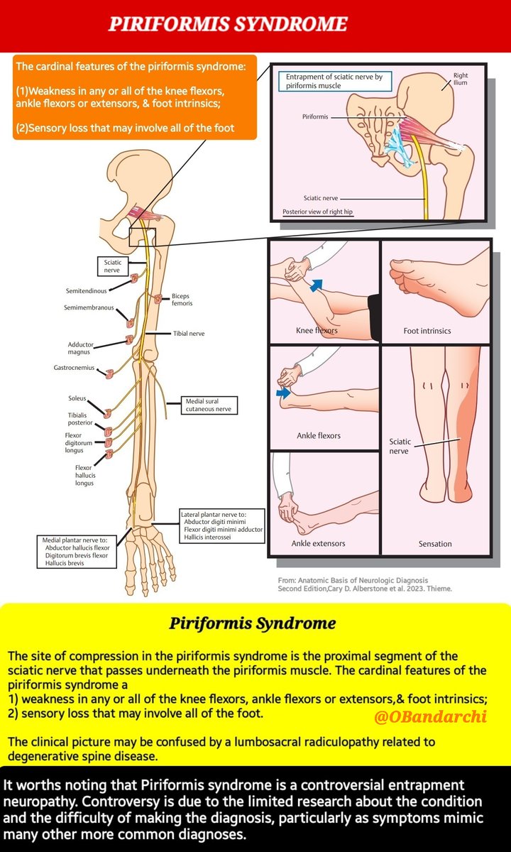 OBandarchi's tweet photo. Piriformis syndrome
a nondiscogenic cause of sciatica from compression of sciatic nerve through or around piriformis muscle.
Its cardinal features: 1)weakness in any or all of the knee flexors,ankle flexors or extensors &amp; foot intrinsics;2)sensory loss may involve all of the foot https://t.co/65rX0vOnSh