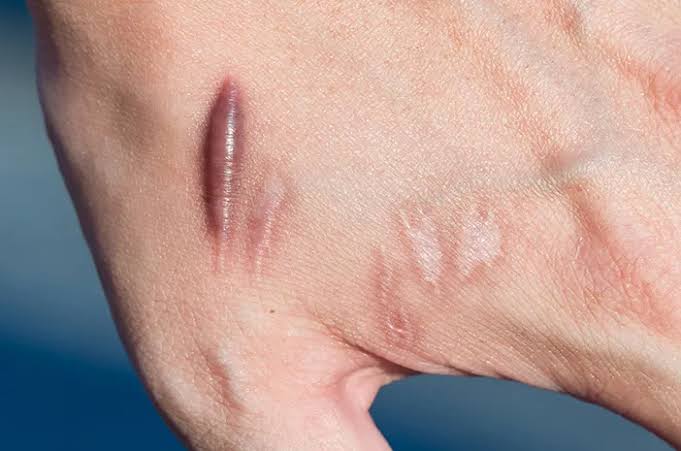 afrkml's tweet photo. Gimana Keloid Terbentuk? Bisakah Dicegah?

— utas

Siapa yg punya keloid?
Ngeselin juga ya klo tiap luka, keloid selalu muncul 🥲
Apakah para sel bisa mencegah kemunculannya? Apa yg harus kita lakukan?
Simak yok! 

#KetikaTubuhBerbicara