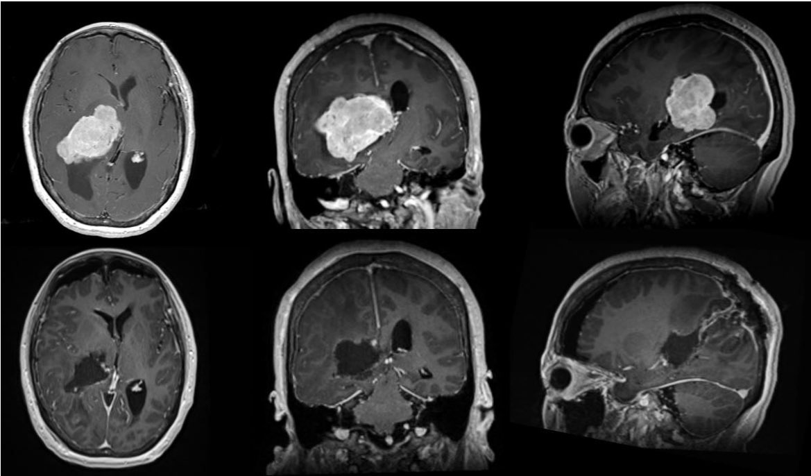 AshishHShah4's tweet photo. We used a tubular trans-sulcal approach through superior parietal lobule. Images below. Pathology was a grade I meningioma. There was actually another small convexity meningioma overlying our entry site which we resected on the way in. #meningioma #vycor https://t.co/jm826AX6oX