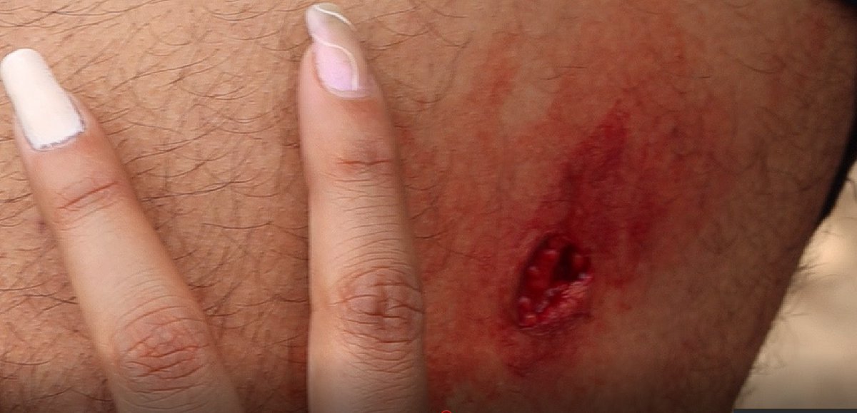 GritosDelCerro's tweet photo. Se acuerdan del personaje que pistola en mano amenazaba a la comunidad, pues acá a unos jóvenes que hacían fotos del ecosistema le echaron los perros (lesiones de mordida) e hicieron caer a uno por una cantera... Cómo duele Cerro seco 😡 @Ambientebogota @SeguridadBOG @ALCBolivar https://t.co/7zmgMKJHq9