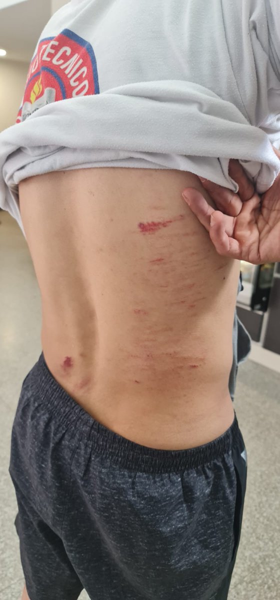 GritosDelCerro's tweet photo. Se acuerdan del personaje que pistola en mano amenazaba a la comunidad, pues acá a unos jóvenes que hacían fotos del ecosistema le echaron los perros (lesiones de mordida) e hicieron caer a uno por una cantera... Cómo duele Cerro seco 😡 @Ambientebogota @SeguridadBOG @ALCBolivar https://t.co/7zmgMKJHq9
