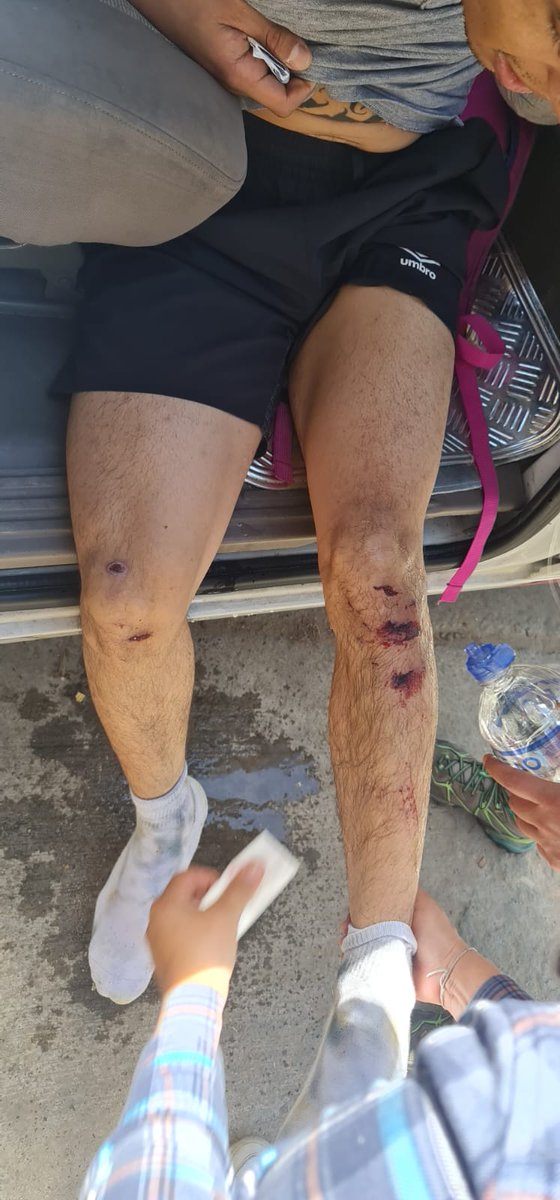 GritosDelCerro's tweet photo. Se acuerdan del personaje que pistola en mano amenazaba a la comunidad, pues acá a unos jóvenes que hacían fotos del ecosistema le echaron los perros (lesiones de mordida) e hicieron caer a uno por una cantera... Cómo duele Cerro seco 😡 @Ambientebogota @SeguridadBOG @ALCBolivar https://t.co/7zmgMKJHq9