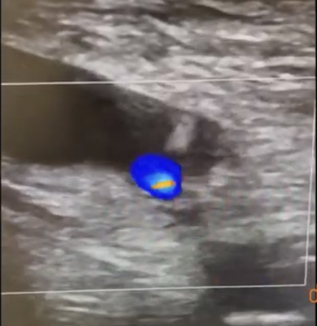 HadyLichaaMD's tweet image. #CathLabHack: #Balloon assisted narrow neck multi-lobed #PseudoAneurysm #ThrombinInjection w distal #EPD

docwirenews.com/post/practice-…

@DNFeldmanMD @Kristen_BrownMD @Pooh_Velagapudi @SVRaoMD @PCRonline @AmitGoyalMD @AnkurKalraMD @SanChris999 @sealtin1 @Allison_Dupont @SripalBangalore