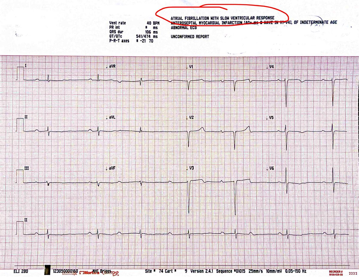 Patient referred for what the ECG labeled “Atrial fibrillation with slow ventricular response.” In this case, don’t buy it! If chest x-rays had automatic interpretations, would we be as trusting? #CardioEd #CardioTwitter #MedEd