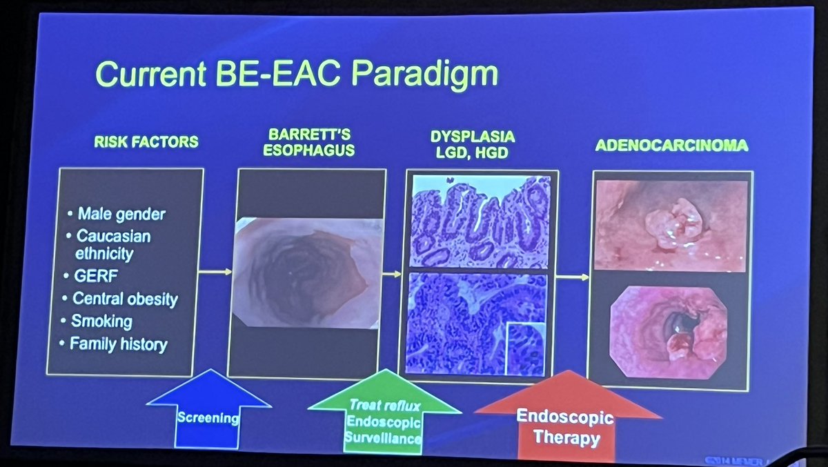 Mariam Naveed, MD (@mn_gimd) on Twitter photo Advances in Screening & Surveillance in BE <a href="/PrasadIyerMD/">Prasad G. Iyer, MD</a> <a href="/MayoClinicGIHep/">Mayo Clinic Gastroenterology & Hepatology</a>
Current BE-EAC Paradigm
3 opportunities for intervention
⭐️Screening
⭐️Surveillance
⭐️Endoscopic Treatment Advances in Screening & Surveillance in BE <a href="/PrasadIyerMD/">Prasad G. Iyer, MD</a> <a href="/MayoClinicGIHep/">Mayo Clinic Gastroenterology & Hepatology</a>
Current BE-EAC Paradigm
3 opportunities for intervention
⭐️Screening
⭐️Surveillance
⭐️Endoscopic Treatment