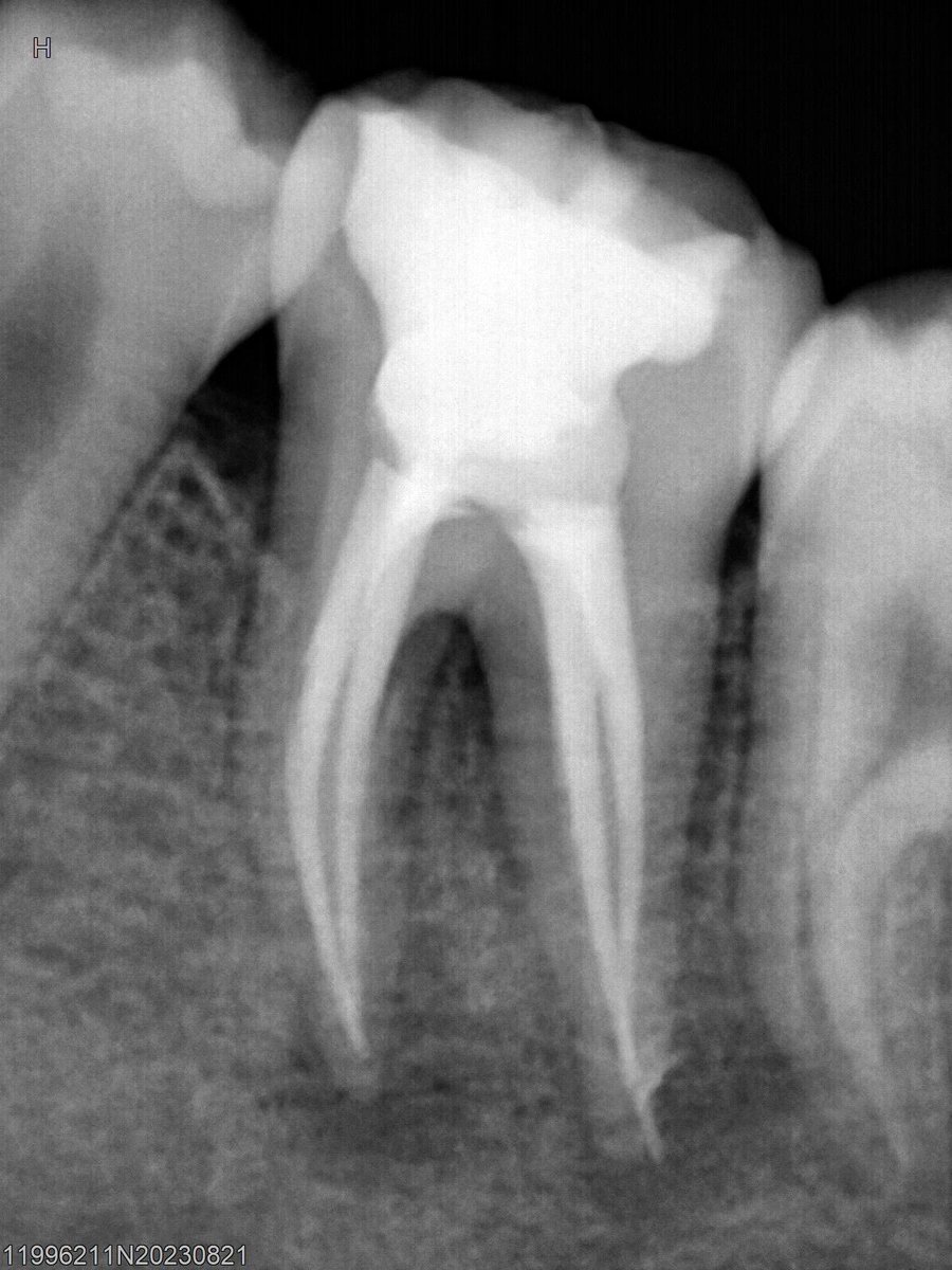 dr_mohammed992's tweet photo. Tooth 🦷 #46 RCT with composite restoration https://t.co/Vbtw0hdT7W