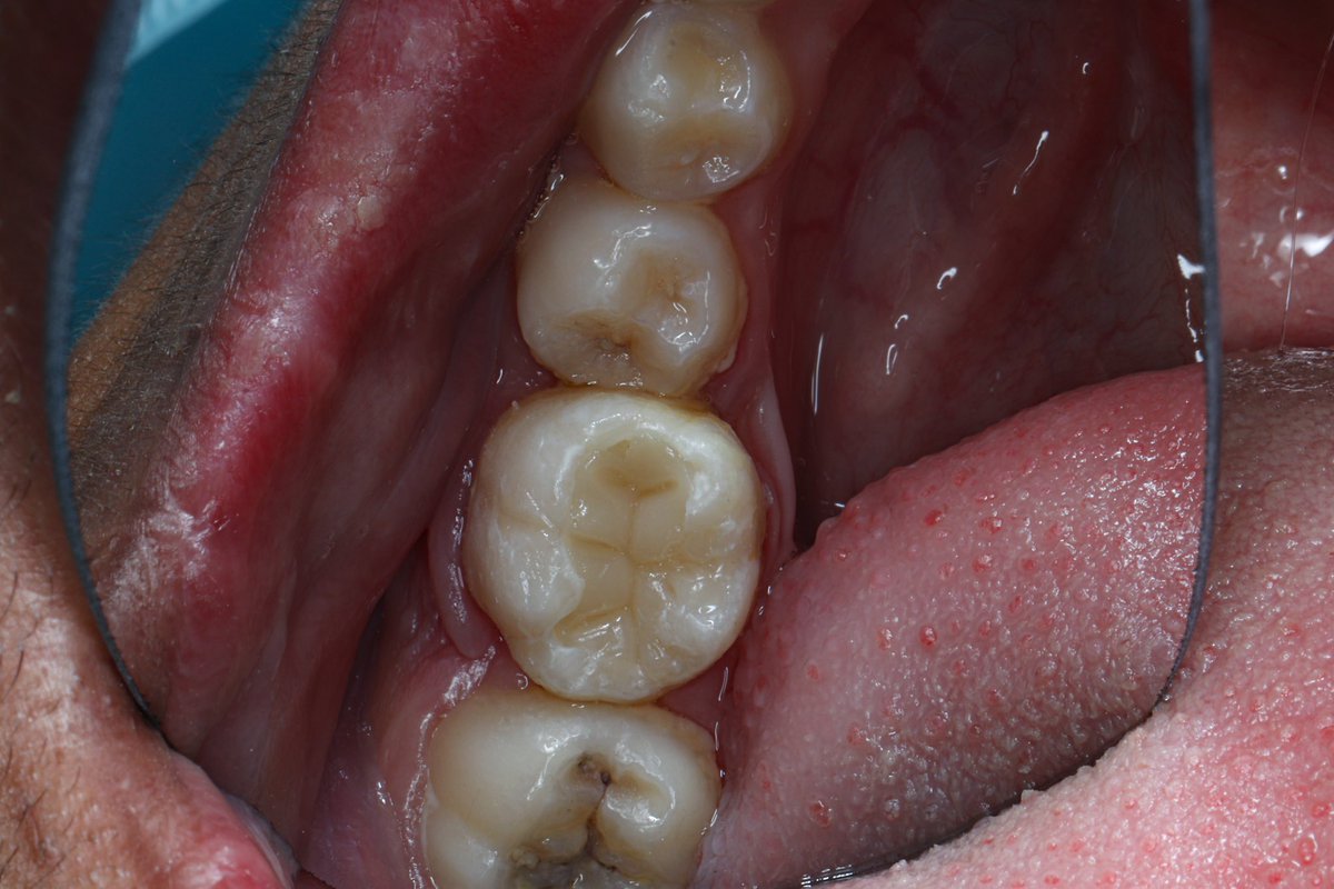 dr_mohammed992's tweet photo. Tooth 🦷 #46 RCT with composite restoration https://t.co/Vbtw0hdT7W