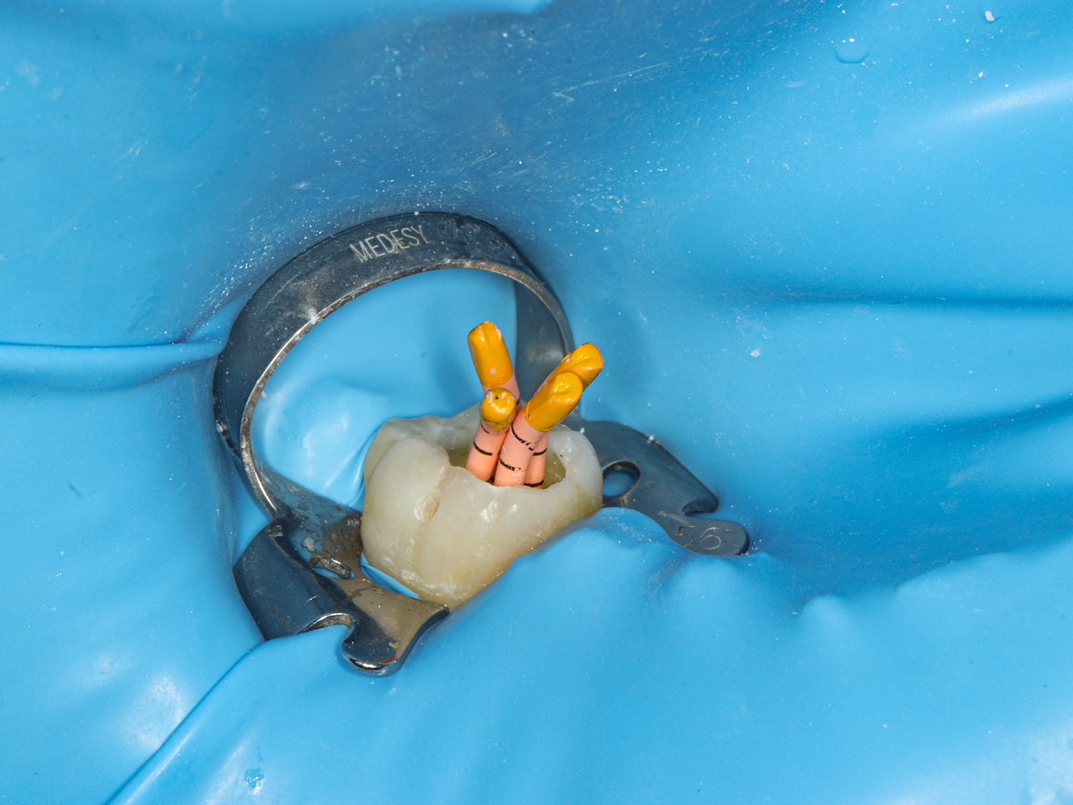 dr_mohammed992's tweet photo. Tooth 🦷 #46 RCT with composite restoration https://t.co/Vbtw0hdT7W