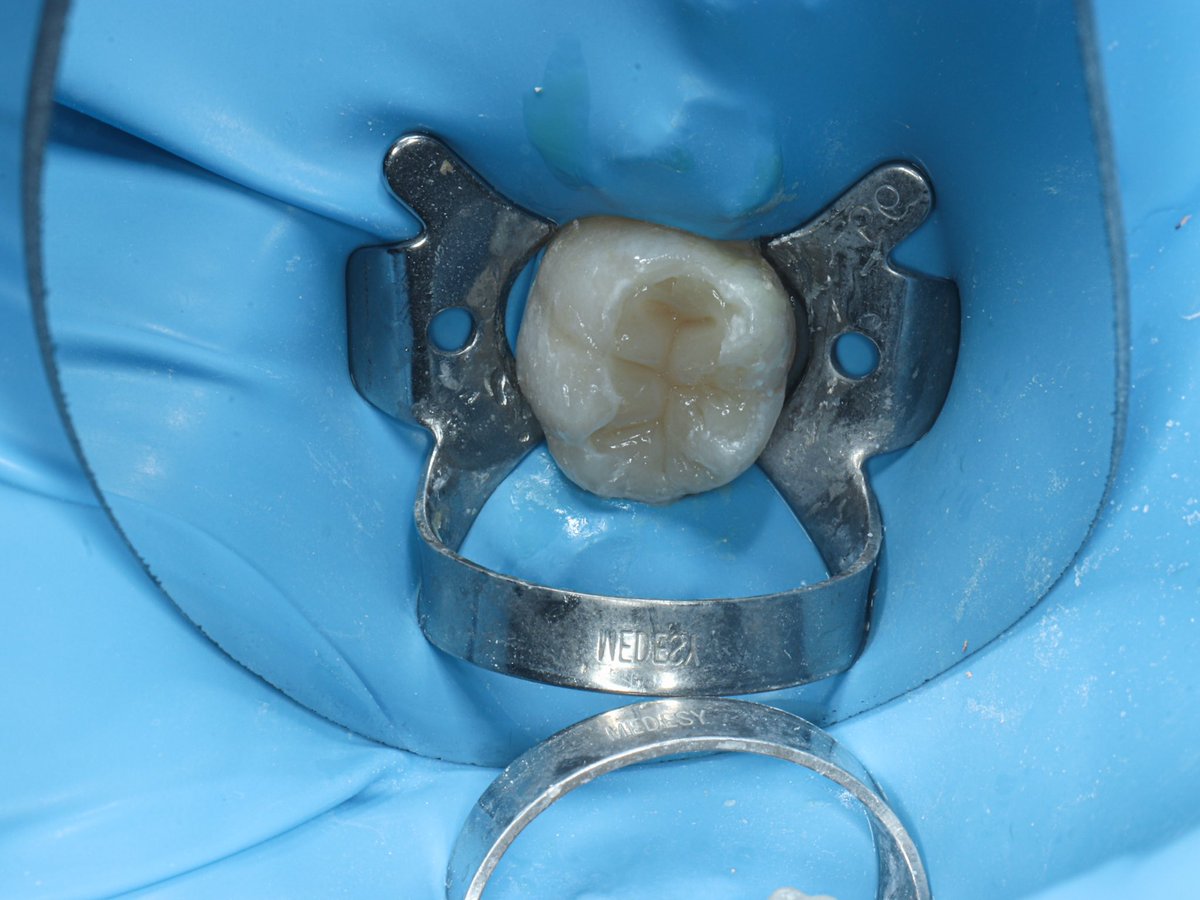 dr_mohammed992's tweet photo. Tooth 🦷 #46 RCT with composite restoration https://t.co/Vbtw0hdT7W