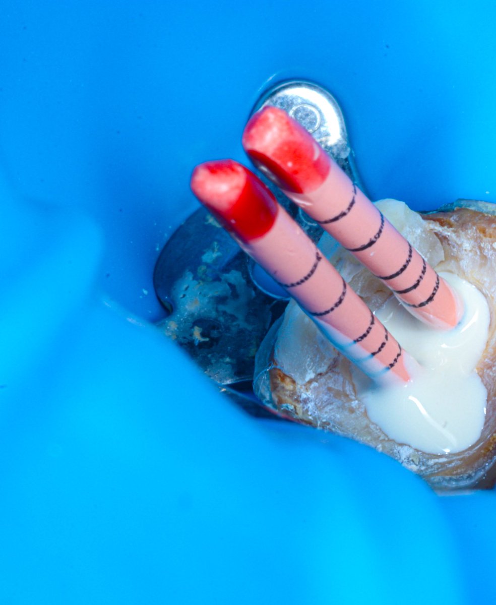 dr_mohammed992's tweet photo. Tooth 🦷 #47 with two canals https://t.co/qaYn8sjCf8