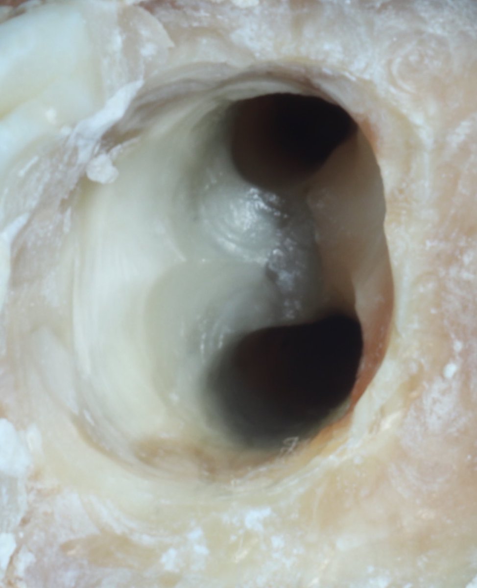 dr_mohammed992's tweet photo. Tooth 🦷 #47 with two canals https://t.co/qaYn8sjCf8