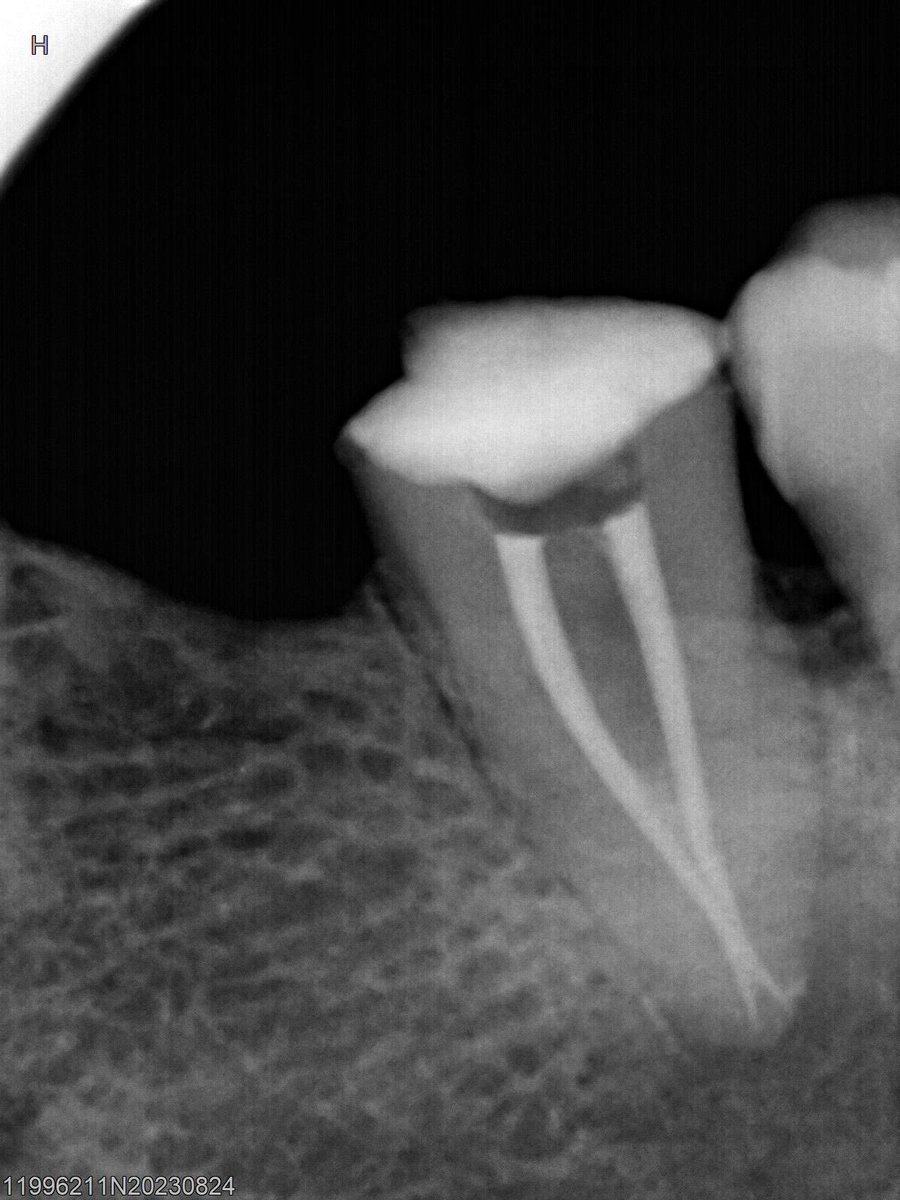 dr_mohammed992's tweet photo. Tooth 🦷 #47 with two canals https://t.co/qaYn8sjCf8