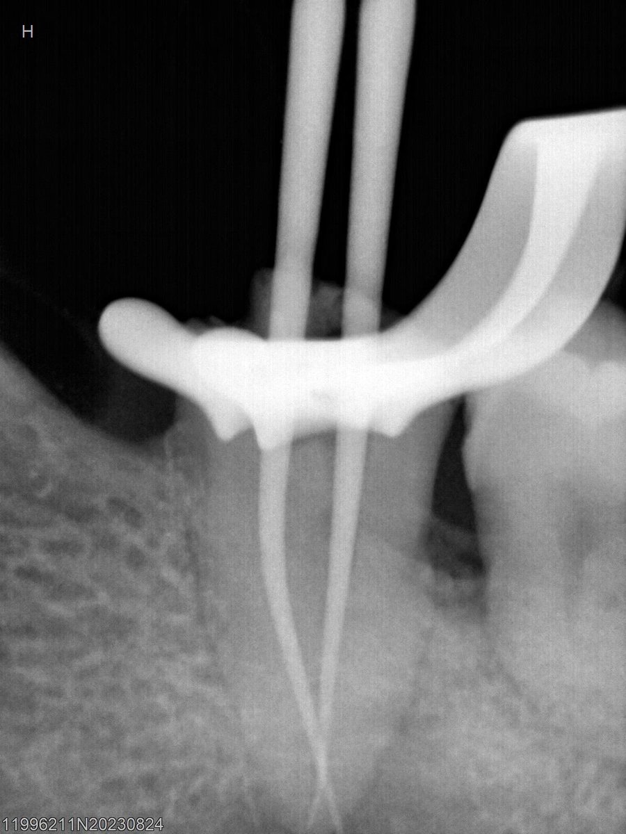 dr_mohammed992's tweet photo. Tooth 🦷 #47 with two canals https://t.co/qaYn8sjCf8