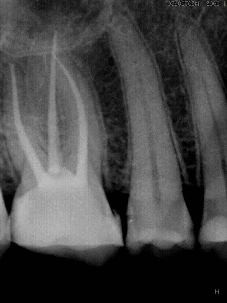 dr_mohammed992's tweet photo. Tooth #26  re treatment https://t.co/Gcivr8Bnqy