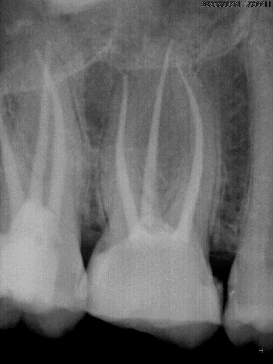 dr_mohammed992's tweet photo. Tooth #26  re treatment https://t.co/Gcivr8Bnqy