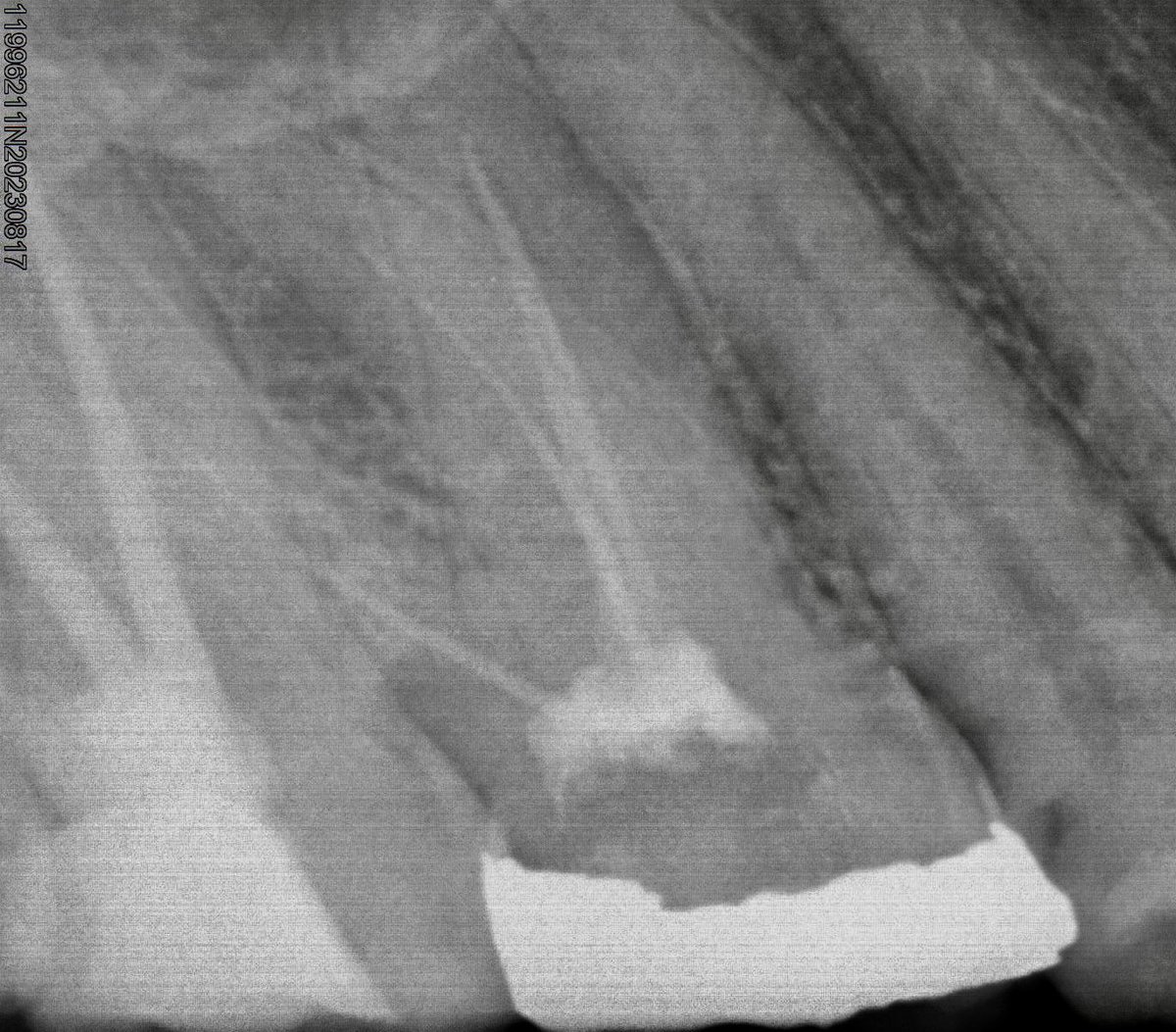 dr_mohammed992's tweet photo. Tooth #26  re treatment https://t.co/Gcivr8Bnqy