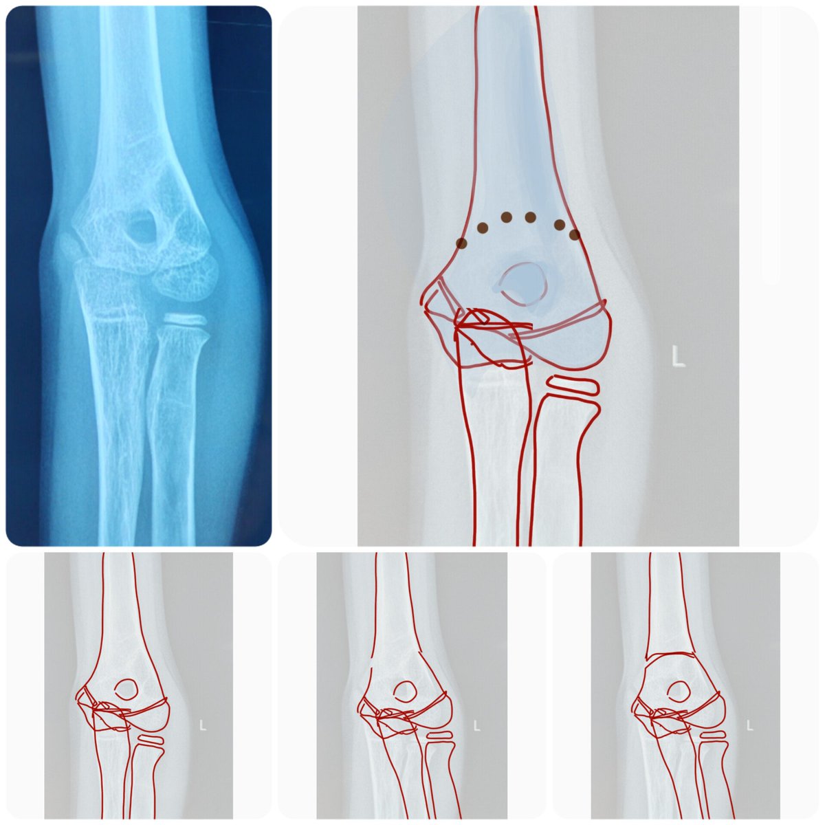 childortho's tweet photo. The complete preop planning for live #surgery. Took just 10 min to do this plan. Take time to plan !
A. #Cubitusvarus correction planning via dome #osteotomy
B. Non union neck of femur fracture with implant cut out planning a #valgus osteotomy of #hip with locking plate fix. https://t.co/PQgdSp0sdV