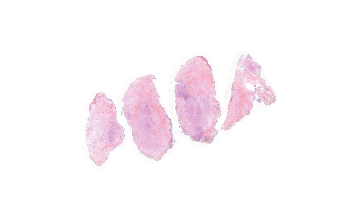 kiko4docs's tweet image. Digit, adult. Diagnosis? 
(You will be shocked!)
Answer: kikoxp.com/posts/7159 
More posts from Dr. Rutland @TristanRutland7 kikoxp.com/tristan_rutlan…
#pathology #pathTwitter #medTwitter #BSTpath