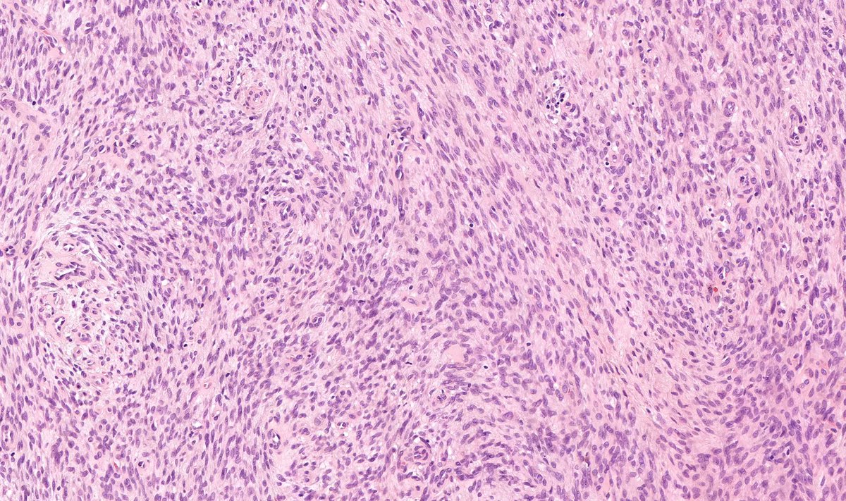 Digit, adult. Diagnosis? (You will be shocked!) Answer: kikoxp.com/posts/7159 More posts from Dr. Rutland @TristanRutland7 kikoxp.com/tristan_rutlan… #pathology #pathTwitter #medTwitter #BSTpath