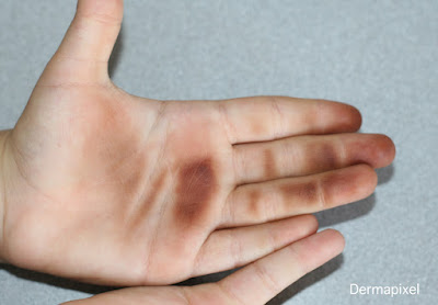 SCPed's tweet photo. 🧐"Manchas marrones en las palmas de las manos", cas de dermatologia pediàtrica al blog #Dermapixel de @rosataberner https://t.co/JHD0N3PQhA https://t.co/0CoRph4JV5