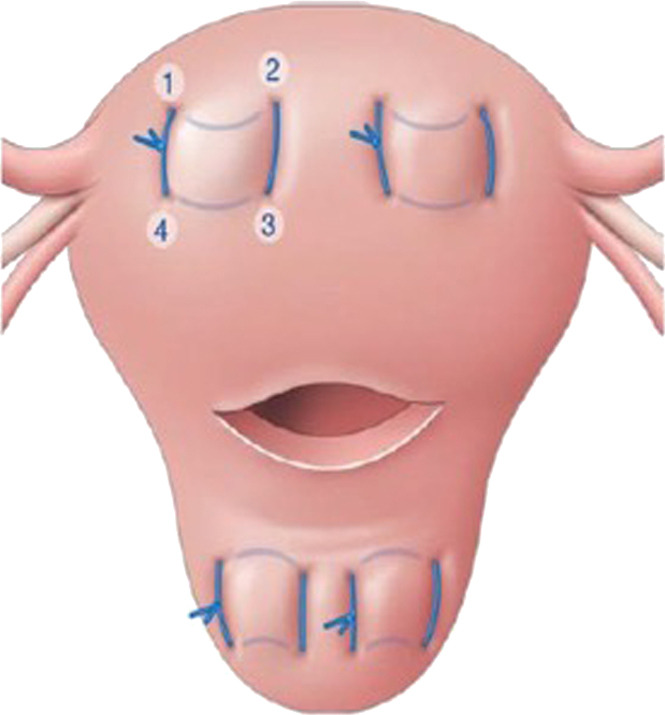 AJOG_thegray's tweet photo. AJOG Expert Review in Labor:  Uterine-sparing surgical procedures to control postpartum hemorrhage - A proposed algorithm of surgical technique to control postpartum hemorrhage refractory to medical treatment https://t.co/5UEbnEWbeI https://t.co/QSvbXFDRWq