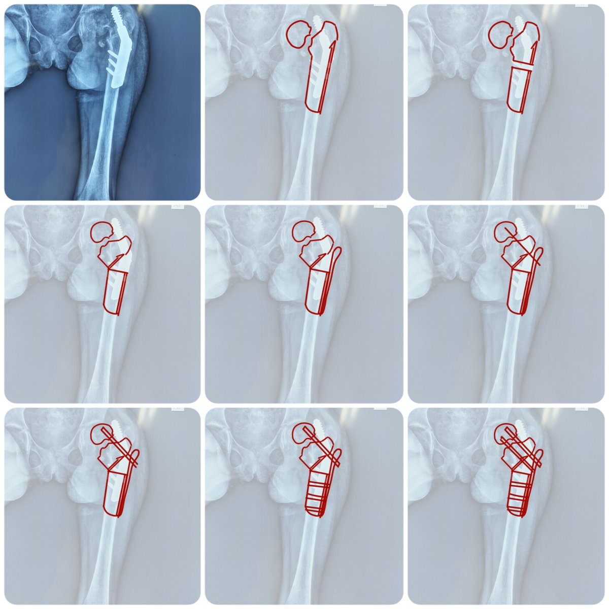 Orthopedic and Trauma Institute (@OrthoTraumaIns) / X