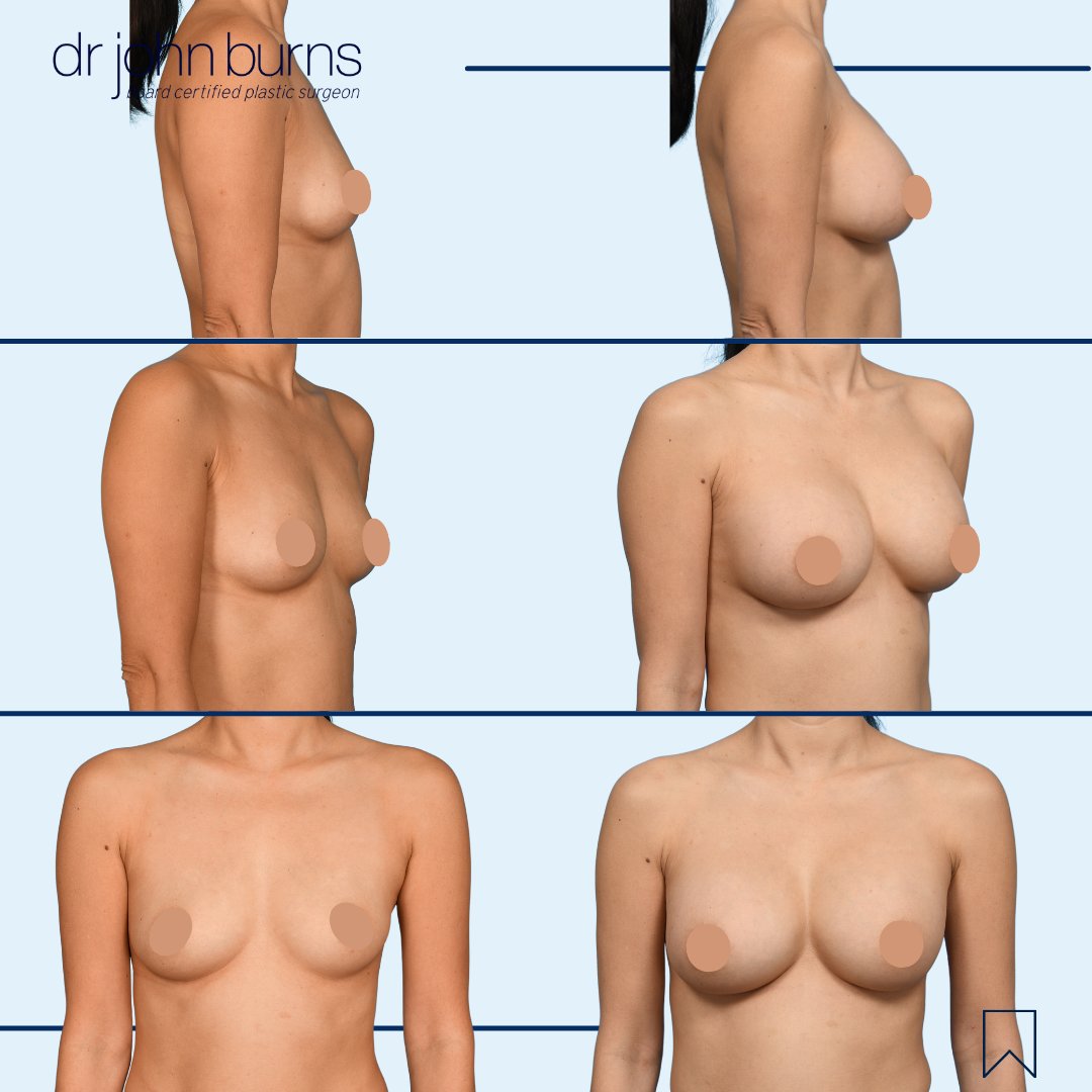 Different size implants provide different results on different patient body  types. She chose a moderate profile 310cc #breastimplant. 310cc gave her a D  cup. It is important to choose your implant based, image size:1080x1080