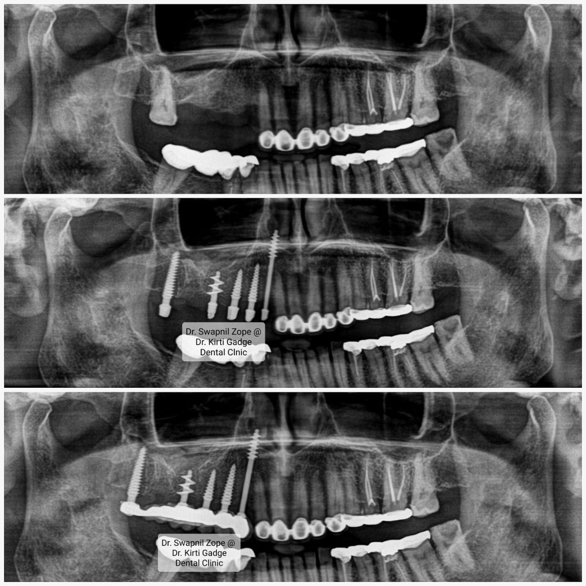 drswapnilz's tweet image. #Immediateloading #Fixedteeth #Teethin72hrs #SuccessStory
#MissingTeeth #Difficultychewingfood #Prosthesis  #CareerInterestDentalImplants #DentistryExperience18years #DentistryMyPassion #DentistryLife #DrSwapnilZope #ConsultationPractice