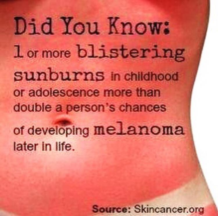 Spending some time in the sun today? Don't forget the sunscreen. #melanoma