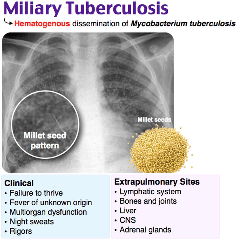 Systemic Manifestation of Miliary Tuberculosis in Patient With Advanced  Diabetic Retinopathy Presenting With Electrolyte Imbalance, Seizures, and  Adrenal Insufficiency | Cureus, image size:960x974
