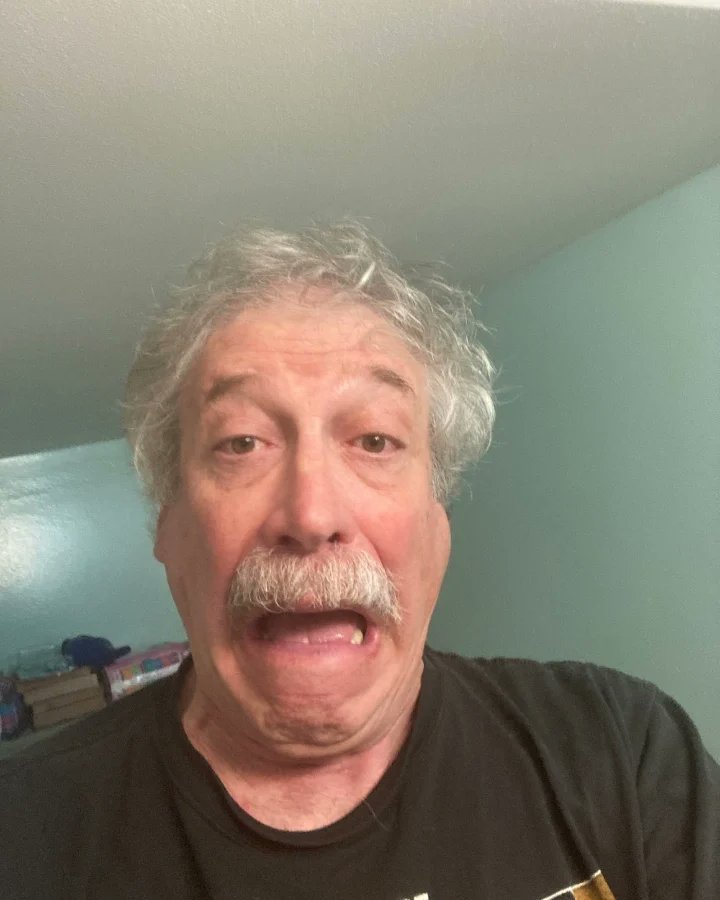 Howardstei42922's tweet photo. I started my 6 day regimen of prednisone this morning. This is the before and after pictures https://t.co/anvPX9gpdo
