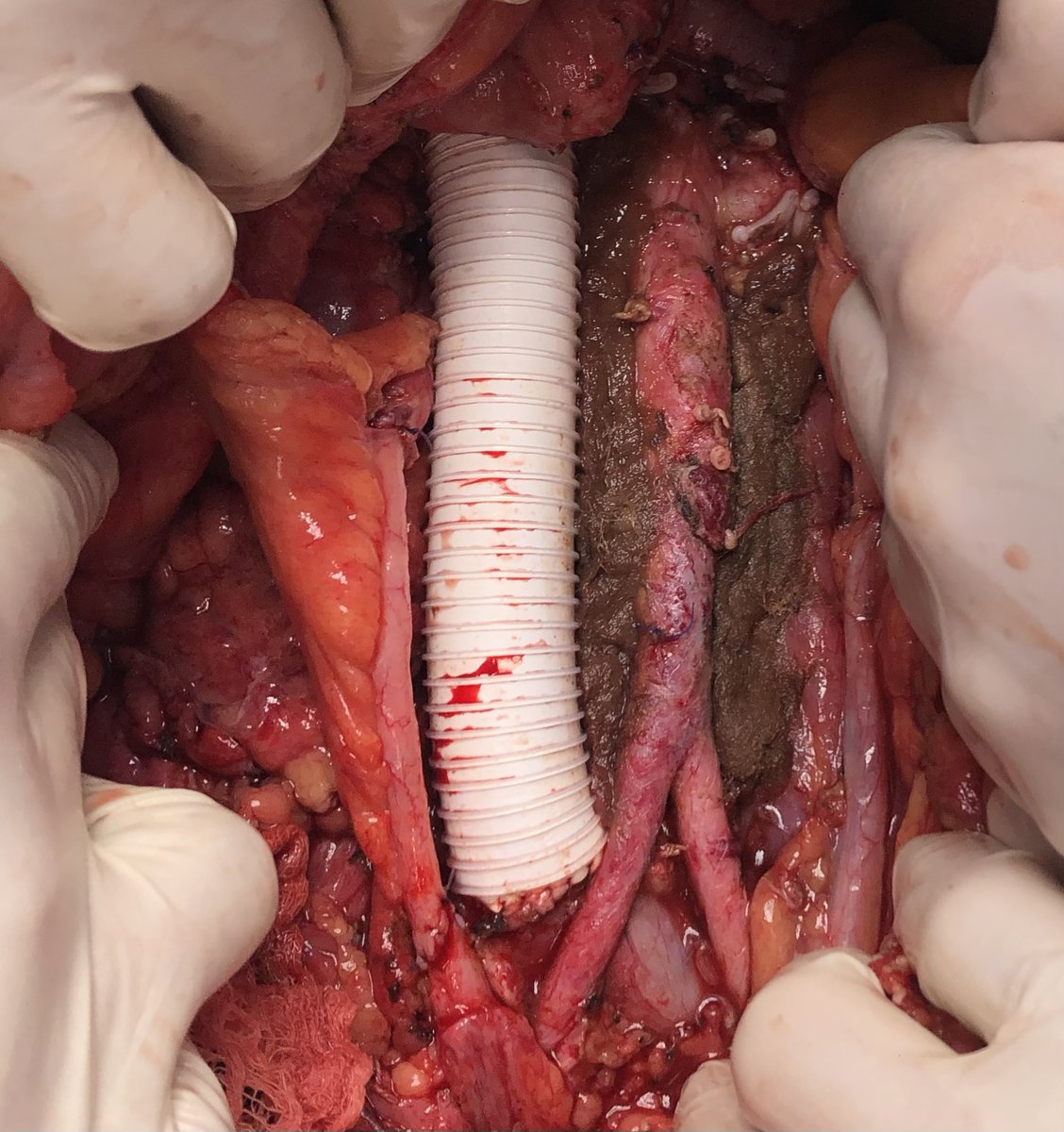 carminattitomas's tweet photo. @fabriziodalmoro @masalek65 @mohamed92902484 @drkemalsarica @fgomsan @urologybug @Mohamedendourol @sbinhamrii We did that technique after a retroperitoneal lymph node disecction https://t.co/M0hi5PL1Fl