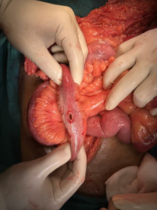 PromedHmis's tweet photo. This was small bowel perforation from typhoid fever, usually caused by Salmonella typhi and parathyphi.   
Case: akm_ipl   

#MedTwitter #MedEd   

Kibe Daniel Kiptoo Scar Faith Kipyegon Kabando Kikuyus Noah Lyles Gabon Snapchat SHAKE BUM WITH CEEC Steve Harvey #Messi𓃵 #InterMiami #BBNaijaAllStars📷📷📷#blackout #MUNNFO #ARSFUL Kalenjins G.O.A.T Cucurella #Budapest2023 Tanzanians