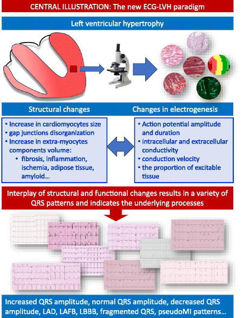 ISE/ISHNE Expert Consensus Statement on ECG Diagnosis of Left Ventricular Hypertrophy #JECG #NewOnline sciencedirect.com/science/articl…