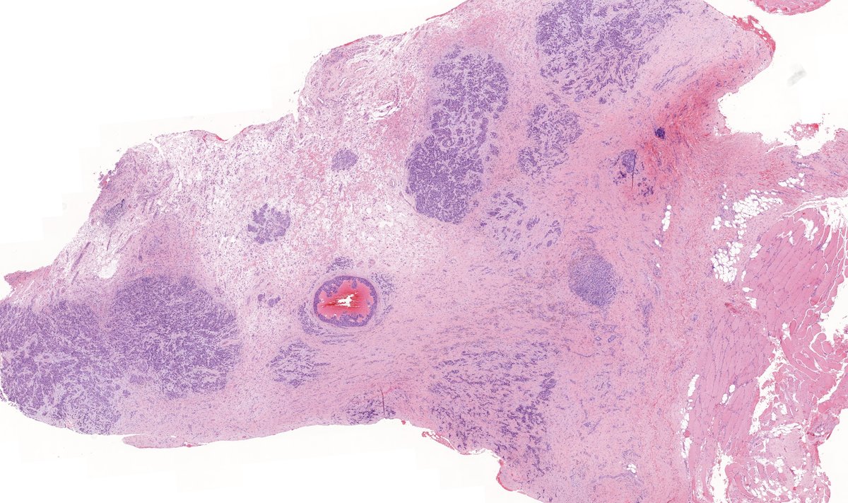 Chest lesion, older male. Diagnosis? Answer: kikoxp.com/posts/9341 More posts from Dr. Rutland @TristanRutland7 kikoxp.com/tristan_rutlan… #pathology #pathTwitter #medTwitter