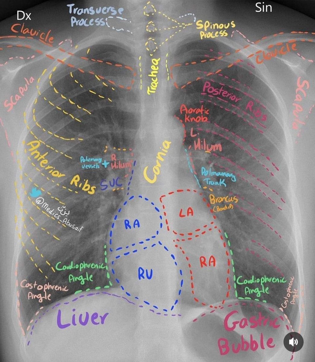 mtcapital2's tweet photo. CXR (normal presentation) https://t.co/nmCjxkQa8y