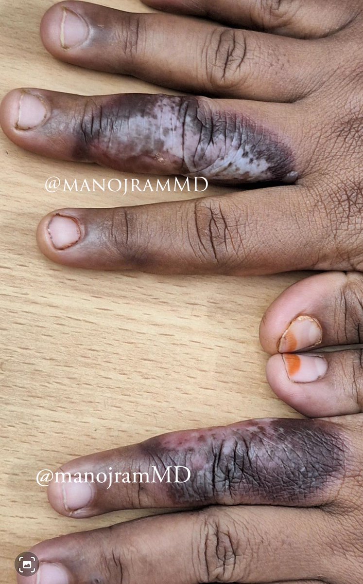 Quiztime24
40 yr F
Recurrent 
Both hands affected 
Itching and burning 
Palmar side also affected 
Erythema seen on Palmar side
#medX #dermX #dermatology #MedEd