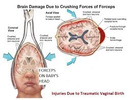 ellyArcaRays's tweet photo. @LePapillonBlu2 Poor Roger,
This is what prolly happened to him at birth. https://t.co/NsXClkpIWX