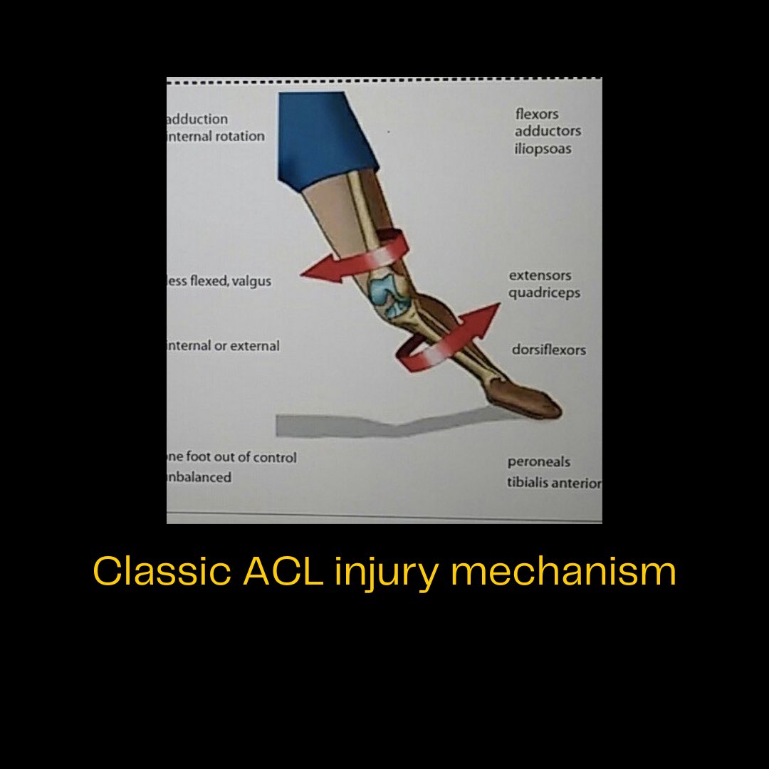 InjuryExplained's tweet photo. Jake Melksham’s left knee collapsed inwards with the non-contact injury episode very close to a classic ACL injury mechanism. Best case scenario would be an isolated meniscus or MCL injury, however, that probably will deem him unfit for the finals too
#afl #AFLSwansDemons https://t.co/p73uHYYSnn