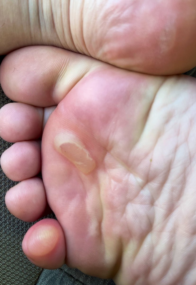 cumcomfy's tweet photo. @Comfy_Fans i’m showing it on this acc so i don’t scare mfers looking for tummy or somthn scrolling thru my media, then WHAM ugly blistered toes 😵💀 https://t.co/R0rwwKYW09