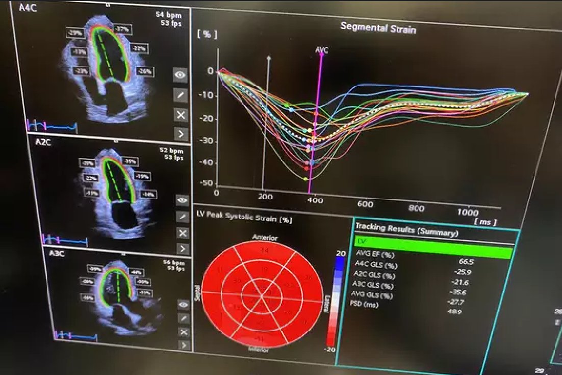 Siemens Healthineers introduces Acuson Origin, a revolutionary cardiovascular ultrasound system with advanced AI capabilities

#AcusonOrigin #AI #AIalgorithms #AIenhancedcardiovascularultrasound #artificialintelligence #cardiovascularimaging

multiplatform.ai/siemens-health…