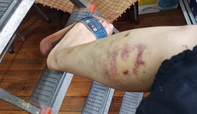 yirmiucderece's tweet image. İBB iştiraki Ağaç A.Ş'de çalışan Hacer Demirlendi, Miniatürk parkında temizlik yaparken İBB Başkan Danışmanı Murat Ongun'a ait olduğu öne sürülen Thor isimli köpeğin saldırısına uğradı.

Yaralanan Demirlendi, şeflerinin işten çıkartma tehditleri yüzünden sessiz kaldı ama