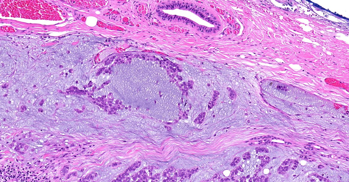 Parotid gland, adult. What is your diagnosis? Answer: kikoxp.com/posts/11790 More posts from Dr. Rutland @TristanRutland7 kikoxp.com/tristan_rutlan… #pathology #pathTwitter #medTwitter #ENTpath